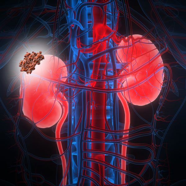 Parsiyel Nefrektomi Ameliyatı