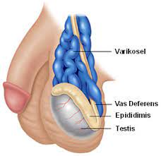 Varikosel Ameliyatı